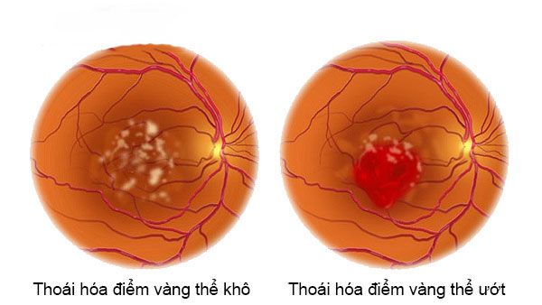 Bệnh thoái hóa hoàng điểm tuổi già