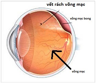 Bệnh võng mạc cận thị nặng