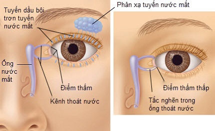 Viêm tắc lệ đạo