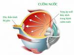 BỆNH GLAUCOMA (CƯỜM NƯỚC) NGUYÊN NHÂN VÀ CÁCH ĐIỀU TRỊ