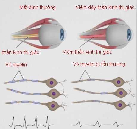 Bệnh lý thần kinh thị giác